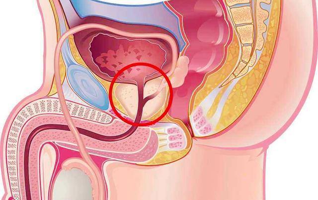 男性前列腺肥大，了解、識(shí)別與應(yīng)對(duì)，男性前列腺肥大，全面解析與應(yīng)對(duì)之道