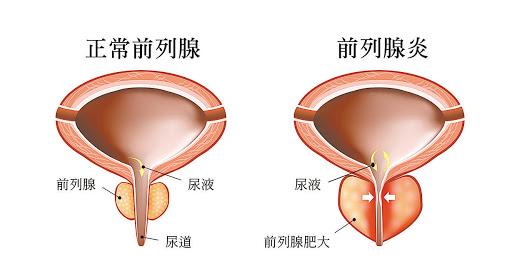 前列腺與性功能關(guān)系