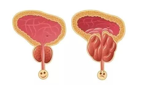 老公的前列腺增大挑戰(zhàn)，理解、支持與共同對(duì)抗，老公前列腺增大，理解、支持與共同應(yīng)對(duì)的挑戰(zhàn)
