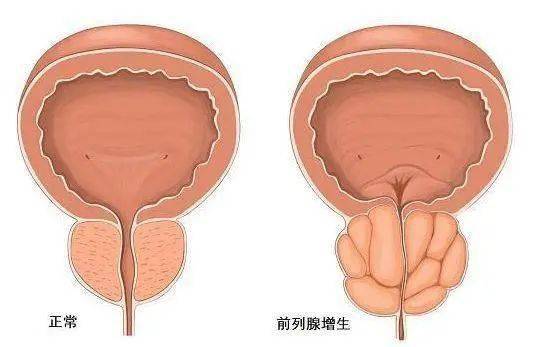 前列腺鈣化，一種常見的前列腺疾病及其相關(guān)知識解析，前列腺鈣化解析，常見疾病與相關(guān)知識探討