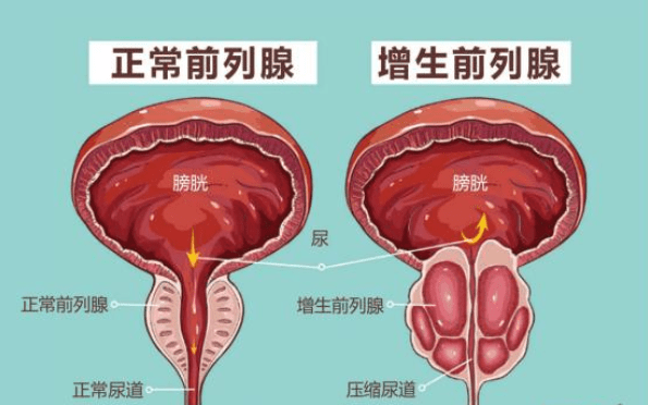 前列腺增生大小標(biāo)準(zhǔn)