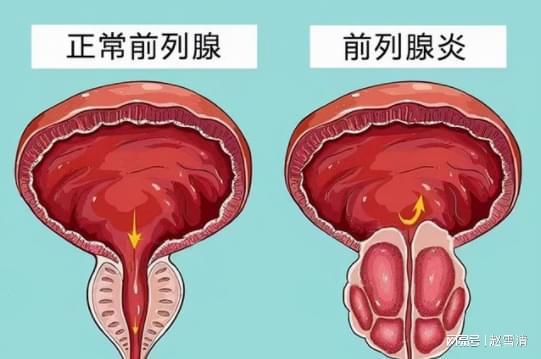 男性前列腺炎的癥狀解析，男性前列腺炎的癥狀詳解