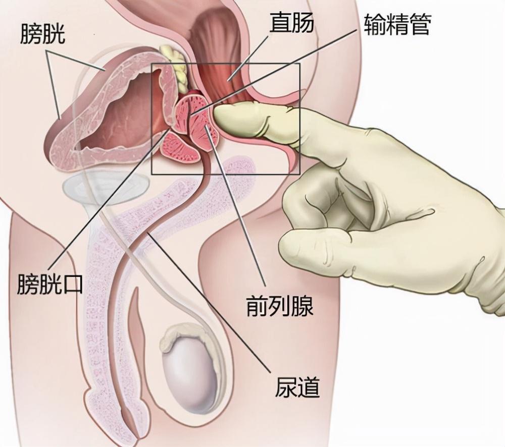 前列腺炎，重新認(rèn)識(shí)男性健康的誤區(qū)，重新認(rèn)識(shí)男性健康誤區(qū)，前列腺炎解析