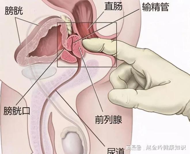 慢性前列腺炎，能否徹底治愈？解析與探討，慢性前列腺炎的治愈可能性解析與探討