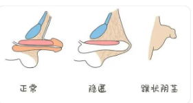 關(guān)于做包皮手術(shù)的費用分析，包皮手術(shù)費用詳解