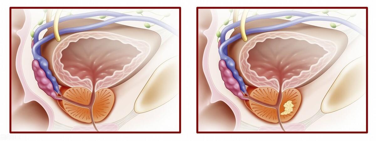 男性前列腺鈣化是什么原因引起的