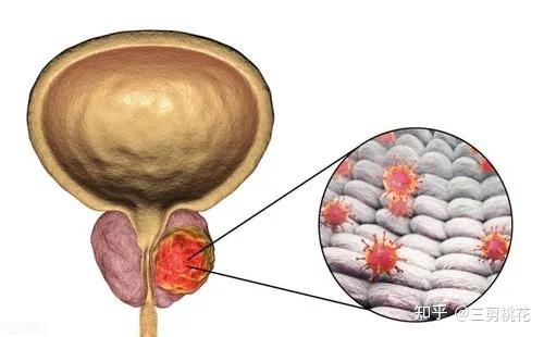 前列腺腫大如何消除，理解、預防與應對策略，前列腺腫大消除策略，理解、預防與應對方法