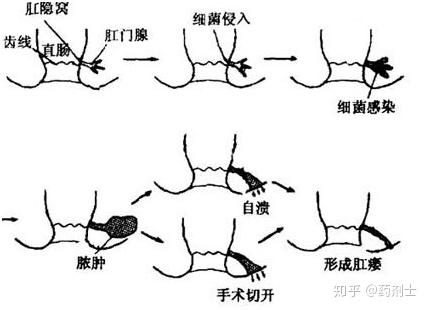 關(guān)于我才17歲陽瘺會自己恢復(fù)嗎的一些探討，關(guān)于17歲陽瘺是否會自行恢復(fù)的探討