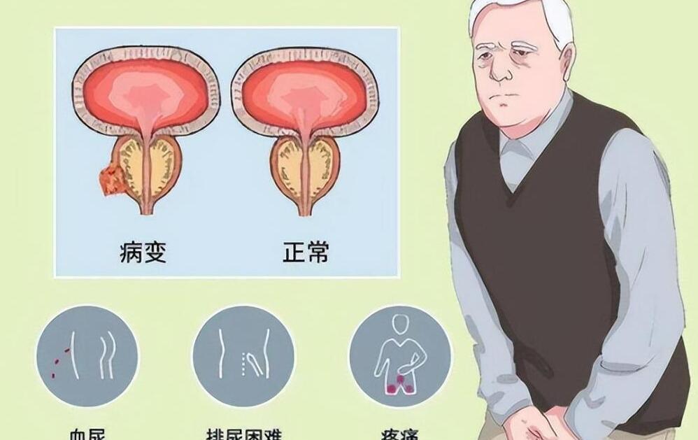 年輕人得了前列腺增大，理解、應對與關注，年輕人前列腺增大，理解、應對與關注的重要性