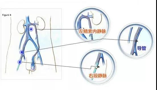 右邊睪丸隱痛會自愈嗎？解析原因與應(yīng)對之道，右邊睪丸隱痛，原因解析與自愈可能性探討