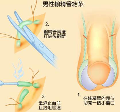 為什么醫(yī)院不提倡男性結(jié)扎，探究背后的原因與考量，探究醫(yī)院不提倡男性結(jié)扎的背后原因與考量