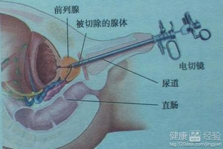 怎么控制前列腺增生