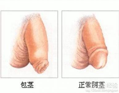 包莖過長對(duì)身體的影響及應(yīng)對(duì)措施，包莖過長對(duì)身體的影響與應(yīng)對(duì)措施解析