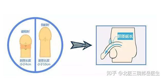 增大延長手術效果探討，手術效果與影響因素分析，增大延長手術效果分析與影響因素探討